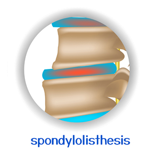 image of Murfreesboro spondylolisthesis